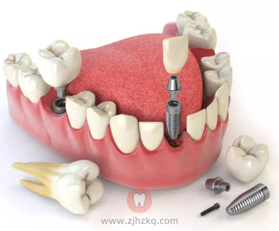 杭州口腔牙科种植牙科普知识看这一篇就够了