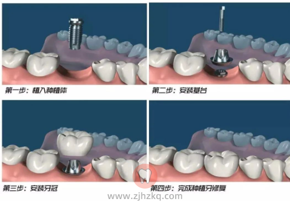 杭州口腔牙科种植牙科普知识看这一篇就够了