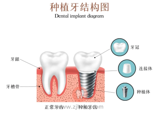 杭州种植牙5000元一颗贵还是便宜