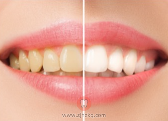 杭州口腔冷光美白科普