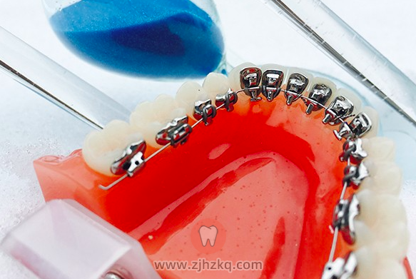 杭州舌侧矫正牙套优点缺点对比