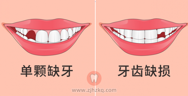 杭州种牙科普长期缺牙有什么危害