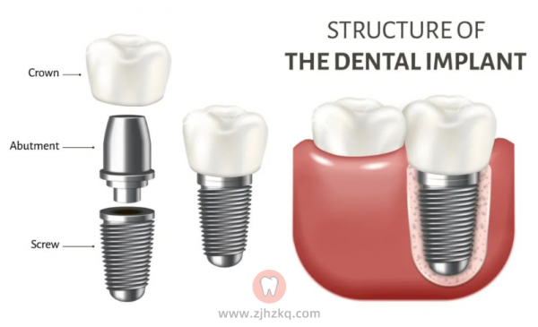 杭州种牙即刻种植口腔科普