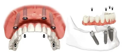 杭州种牙即刻种植口腔科普