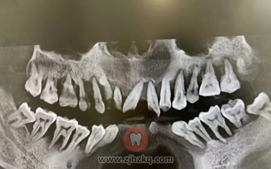 杭州口腔牙周炎口腔科普
