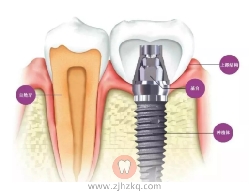萧山种牙哪个牙科医院好附萧山种植牙医生名单