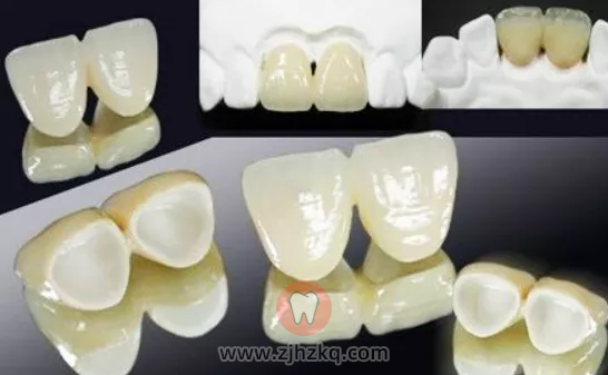杭州镶牙全瓷牙冠多少钱一颗