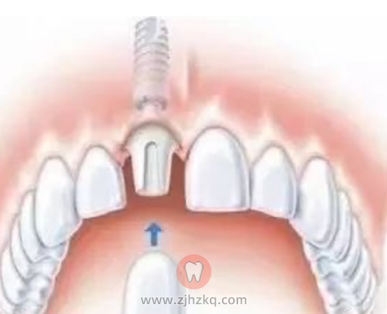 杭州种植牙便宜技术最好的口腔医院是哪家