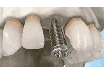 种植牙缺点