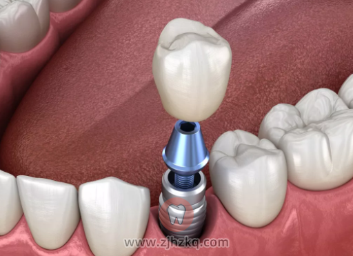 活动假牙和种植牙区别对比怎么选择