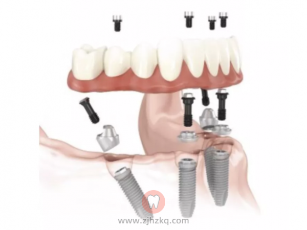 杭州全口种植牙费用价格一共要多少钱