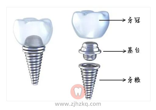 杭州种植牙三千能做吗靠不靠谱