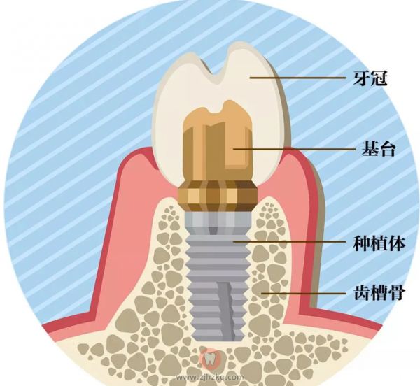 杭州种植牙有3000元的价格吗三四千的种植牙可靠不靠谱
