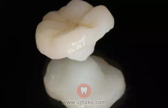 杭州补牙嵌体科普分享