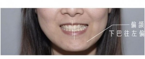 杭州牙齿畸形凸嘴矫正口腔科普