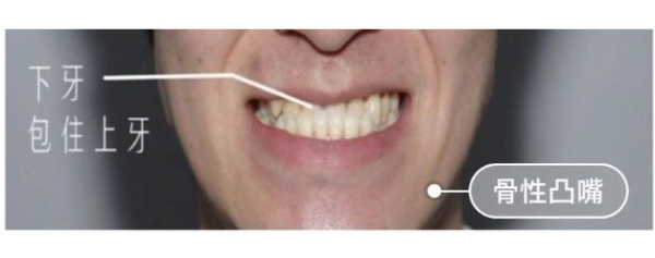 杭州牙齿畸形凸嘴矫正口腔科普