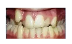 杭州牙齿畸形凸嘴矫正口腔科普