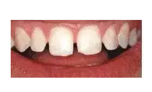 杭州牙齿畸形凸嘴矫正口腔科普