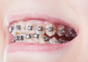 杭州牙齿畸形凸嘴矫正口腔科普