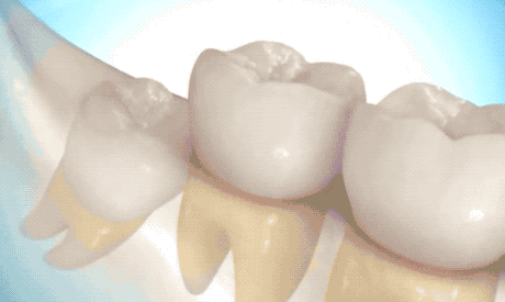 为什么杭州现在拔个智齿这么贵杭州拔牙太贵了