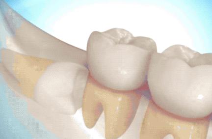 为什么杭州现在拔个智齿这么贵杭州拔牙太贵了