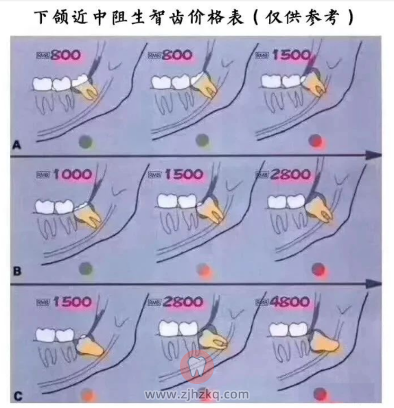 杭州拔智齿价格表价目表