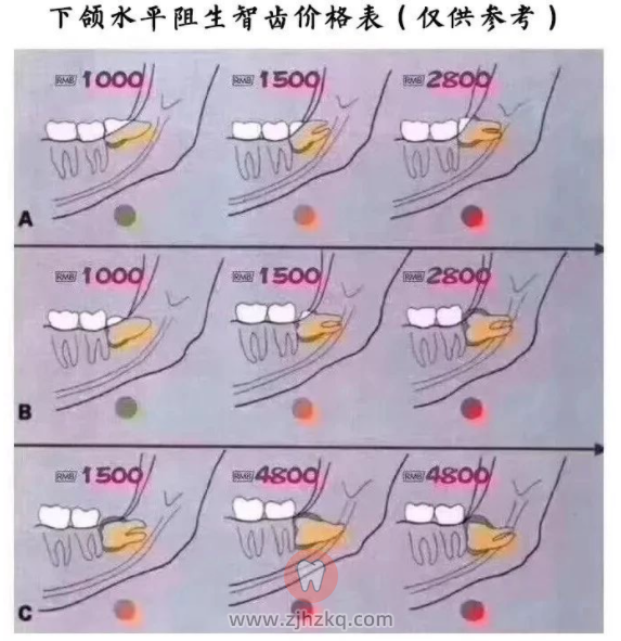 杭州拔智齿价格表价目表