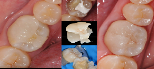杭州牙体缺损修复体口腔科普