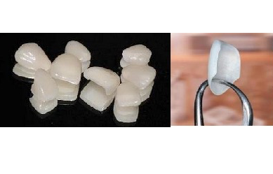 杭州牙体缺损修复体口腔科普