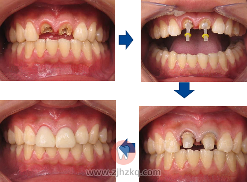 杭州牙体缺损修复体口腔科普