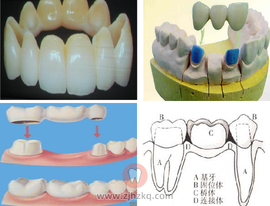 杭州牙列缺损修复体口腔科普