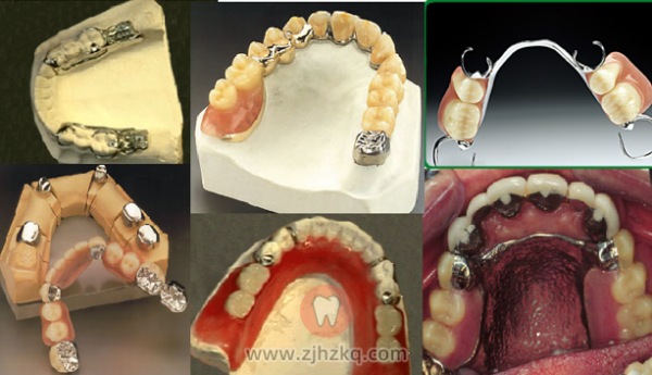 杭州牙列缺损修复体口腔科普