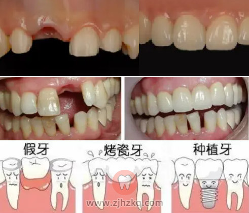 杭州牙列缺损修复体口腔科普