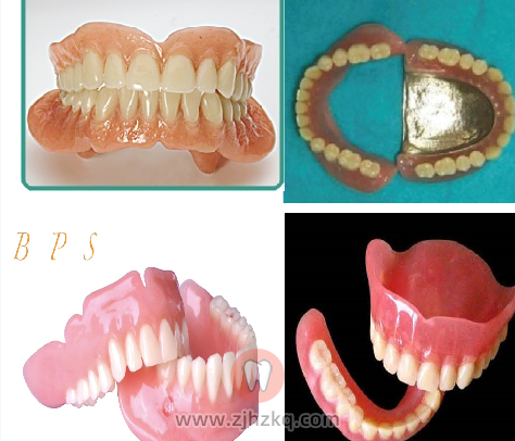 杭州牙列缺损修复体口腔科普