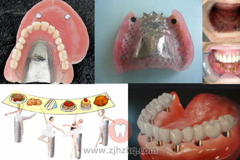 杭州牙列缺损修复体口腔科普