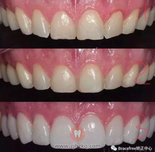 杭州牙贴面一颗2000元贵不贵全口瓷贴面价格