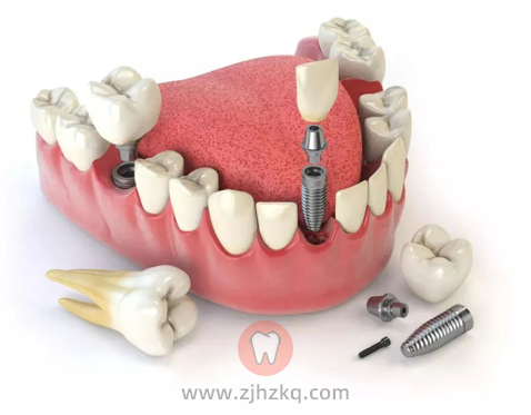 什么是种植牙?有哪些优点?