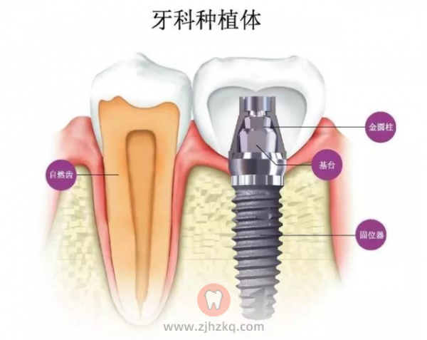 杭州主流的牙科种植体品牌