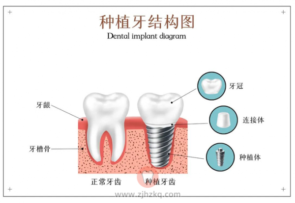杭州西湖口腔科普种植牙品牌如何选择