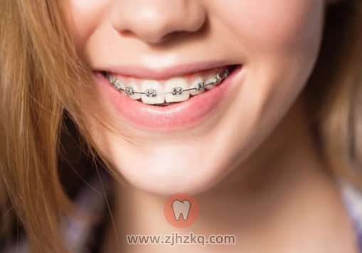 杭州口腔科普正畸托槽掉了怎么办