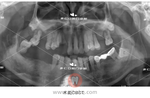 杭州多仁口腔无痛微创半口种植牙案例