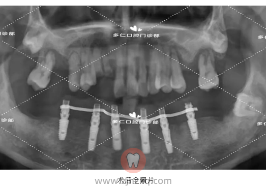 杭州多仁口腔无痛微创半口种植牙案例