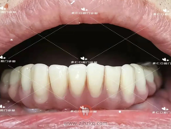 杭州多仁口腔无痛微创半口种植牙案例