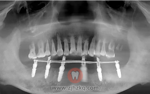 杭州西湖口腔医院叶宝定医生全口种牙记