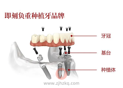 杭州口腔科普种植牙缺几颗牙种几颗吗