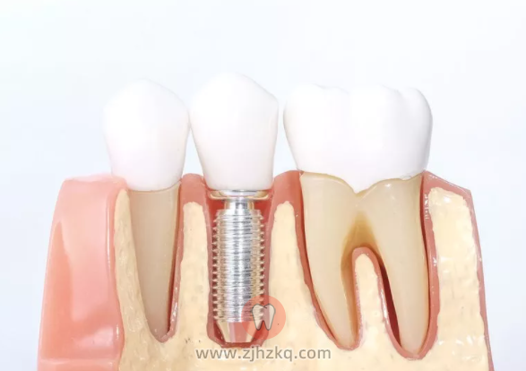 杭州口腔科普牙槽骨萎缩导致假牙老掉做种植牙