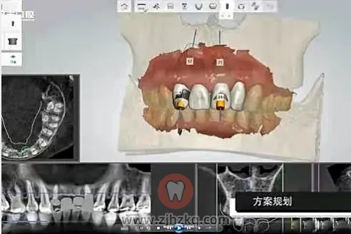 杭州口腔科普数字化种牙
