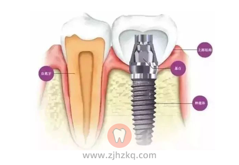 杭州口腔科普儿童学生是否可以做种植牙