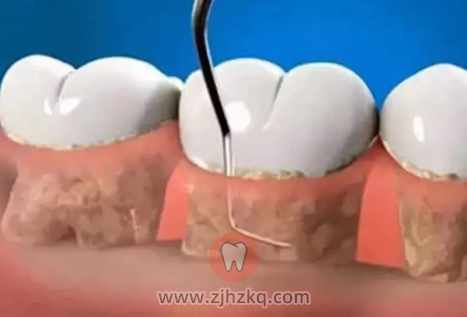 杭州口腔科普牙龈萎缩牙龈退缩