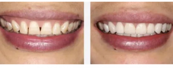 杭州正畸科普牙齿矫正后黑三角牙龈萎缩